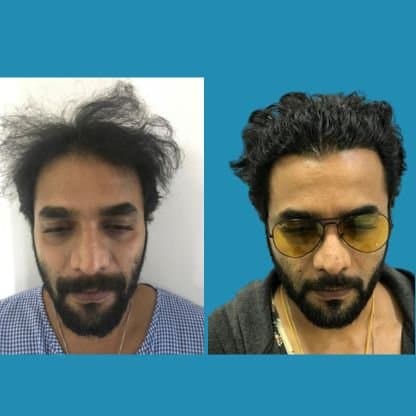 Hair Transplant Cost